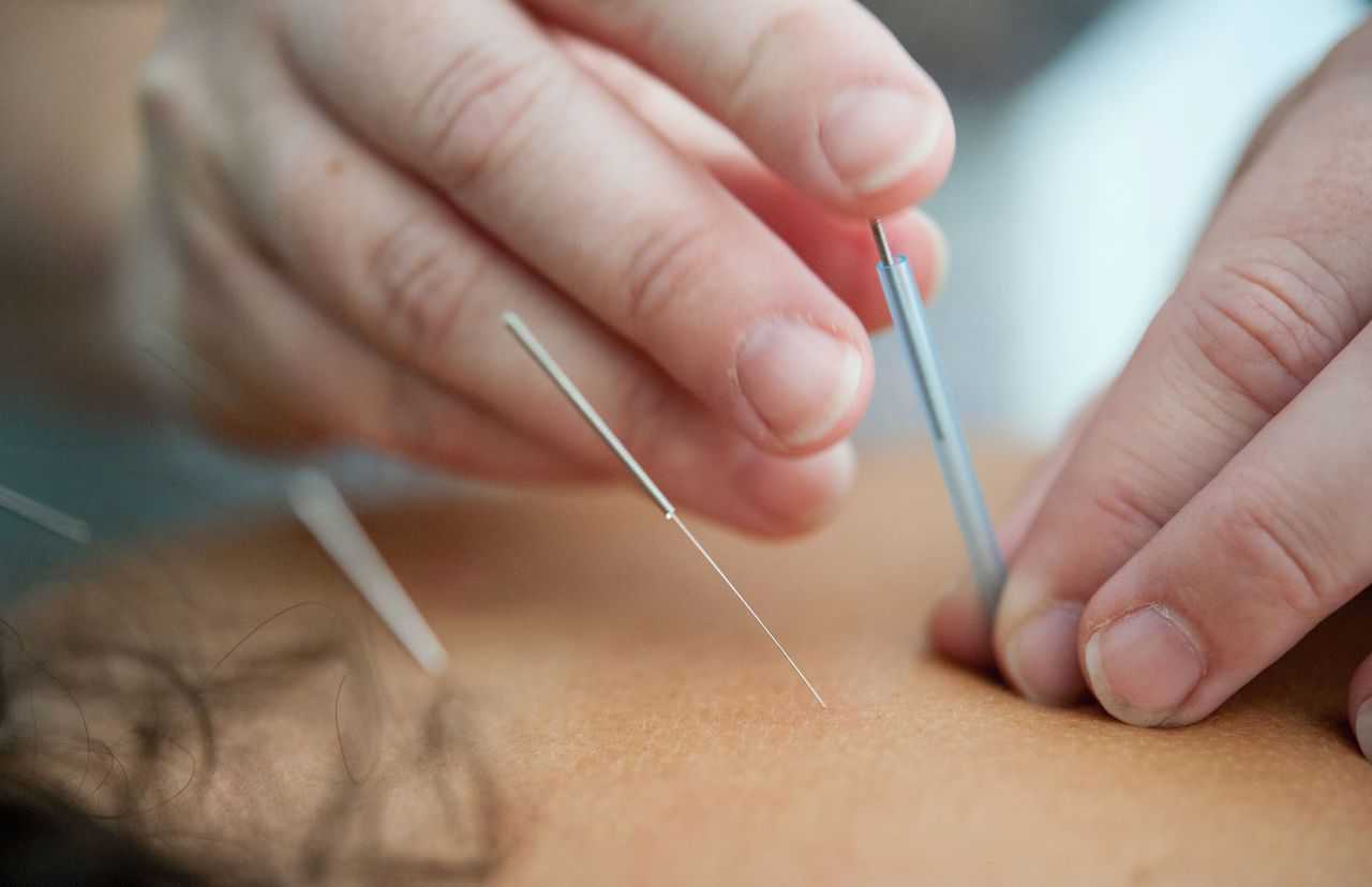 Image of person conducting acupuncture